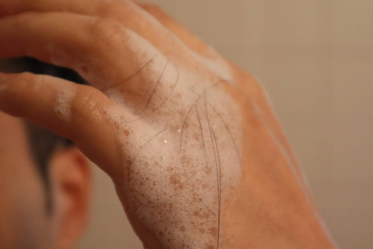 男性の薄毛治療に効果的な薬とは？ハゲ防止の秘策を美容皮膚科が解説
